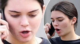 I dvaadvacetiletou topmodelku Kendall Jenner trápí akné.