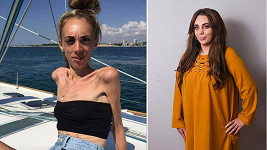 Dieta, kterou si Hannah Lucas (23) už v mladém věku naordinovala, se brzy zvrtla v anorexii.
