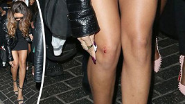 Rihanna si poranila koleno.