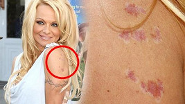 Pamela Anderson a její jizvy na ruce.