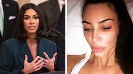 Kim Kardashian promluvila o boji s kožní nemocí. 
