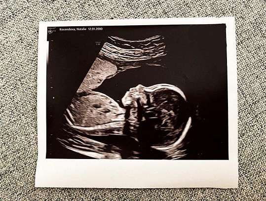 Zveřejnila fotku z ultrazvuku.
