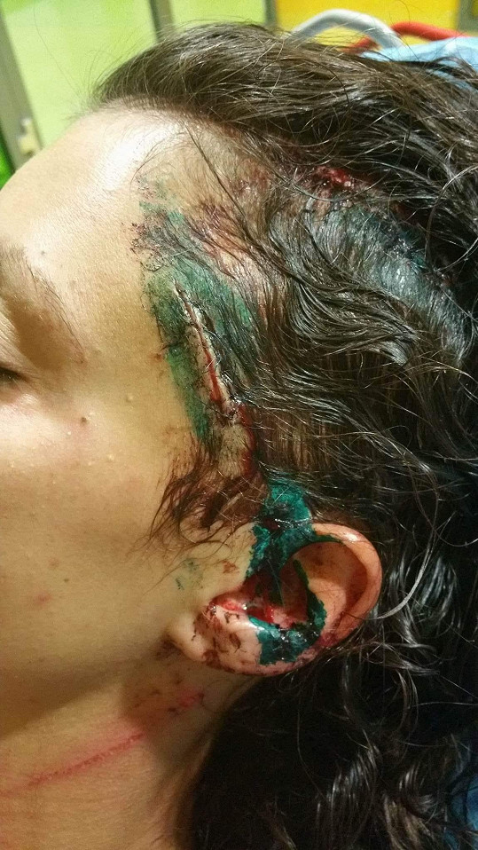 Takhle vypadala některá z jejích zranění krátce po útoku.
