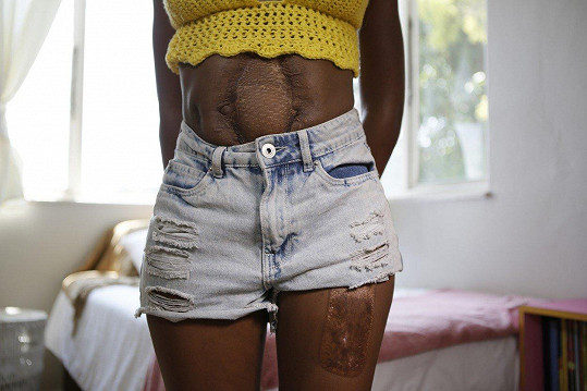 Na díru v břiše lékaři použili kůži z jejího stehna.