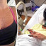 Kvůli piercingu v bradavce skončila mladá žena bez prsu